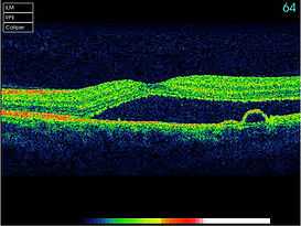 Age-related macular degeneration